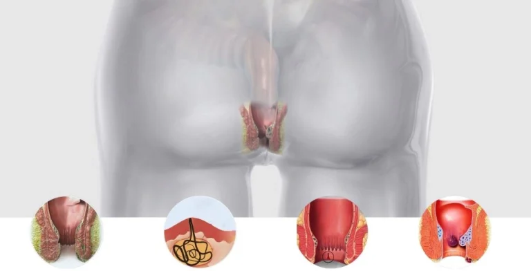 Laser Treatment of Hemorrhoids 1