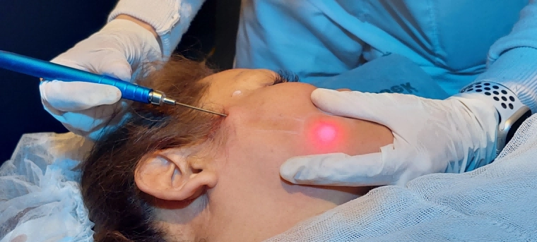 Arfurla Facial Endo Laser BodyliftLipolysis Laser Treatment
