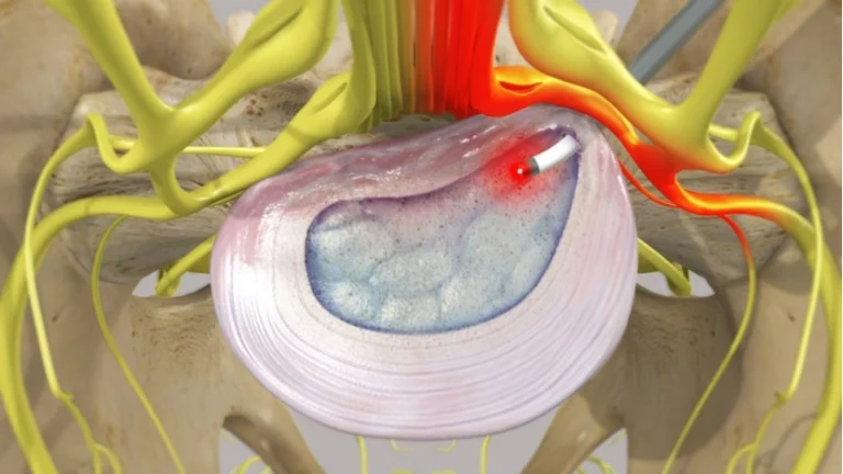 What Is PLDD Laser Treatment and How It Helps Relieve Disc Pain