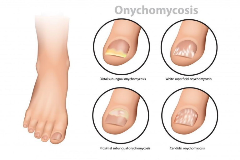 nail tonail fungus laser1