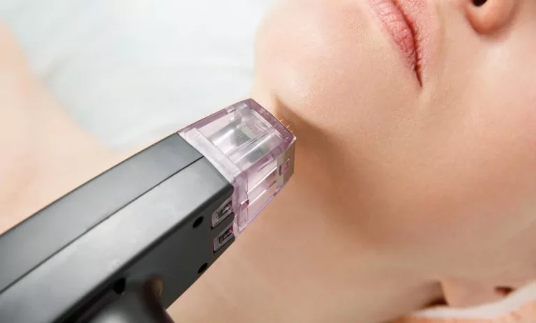 Everything You Need to Know About RF Microneedling
