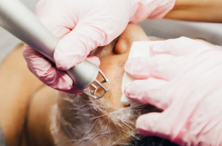 How CO2 Fractional Laser Improves Acne Scars and Pigmentation