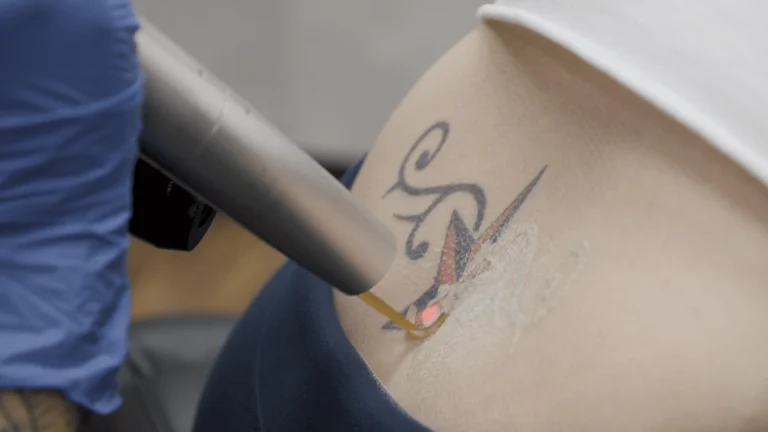 The Benefits of Pico Lasers for Tattoo Removal Business