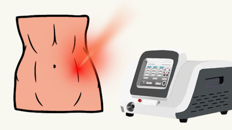 Advantages of 980nm and 1470nm Dual-Wavelength Diode Laser for Lipolysis