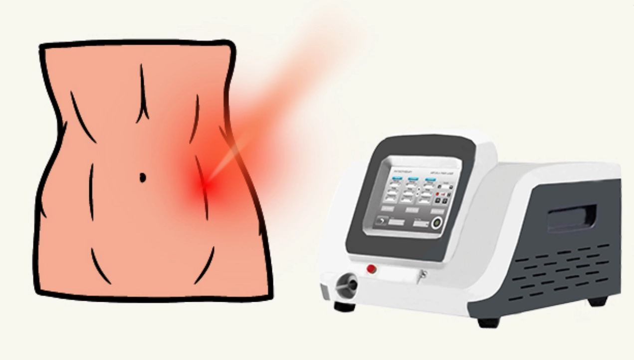 Arfurla 980nm 1470nm Endolift Laser Facial Bodylift Machine