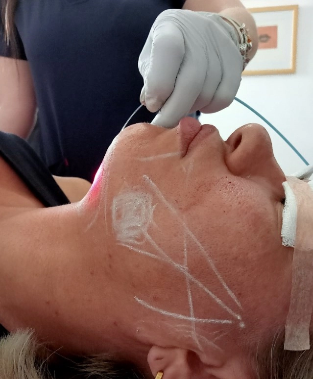 Facial Endo Laser Bodylift Lipolysis Laser Treatment