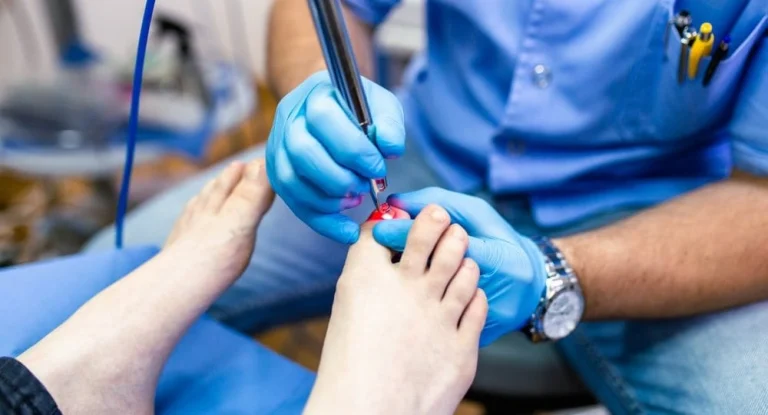 Why Laser Is Currently The Best Fungal Nail Treatment