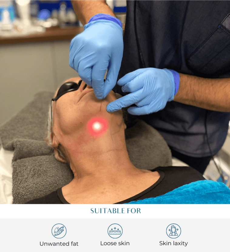 endo-lift laser lipolysis Endolift Treatment