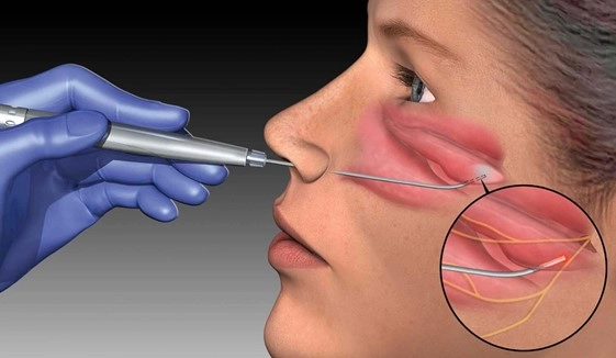 ENT Disorders Laser Treatment device manufacturer