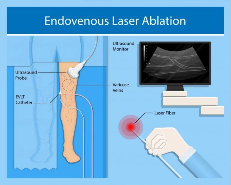 Endovenous Laser Treatment (EVLT) Using a Laser for Varicose Veins