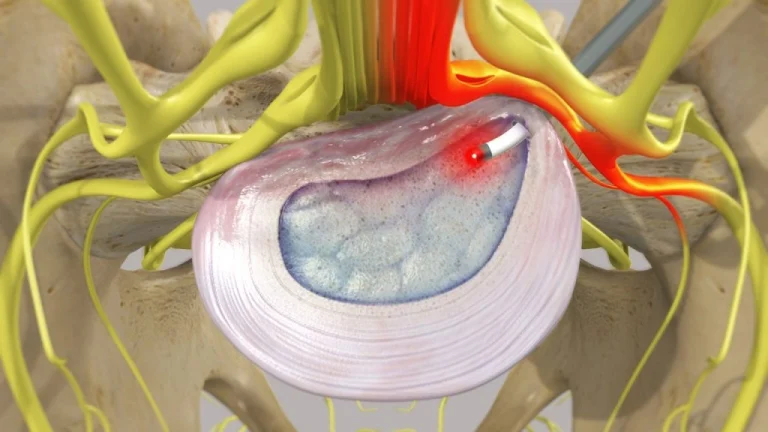 Laser Machine for PLDD Treatment How It Works and Benefits