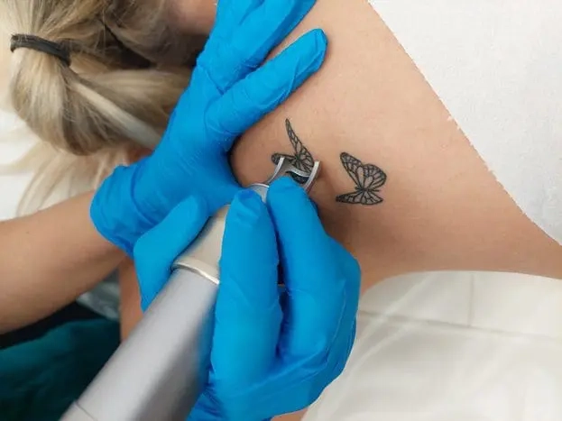 Debunking the Pico Laser Hype Why Q-Switch Lasers Are Still the Gold Standard for Tattoo Removal