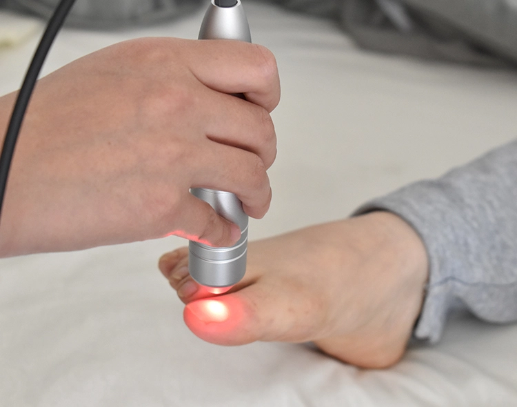 What is 980nm Laser for Nail Fungus Removal