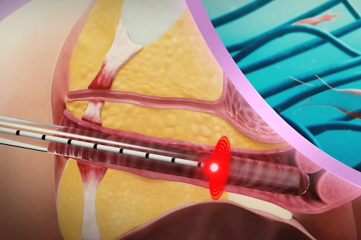 Diode Laser Machines for Gynecology Procedures The New Age of Change in Women’s Health