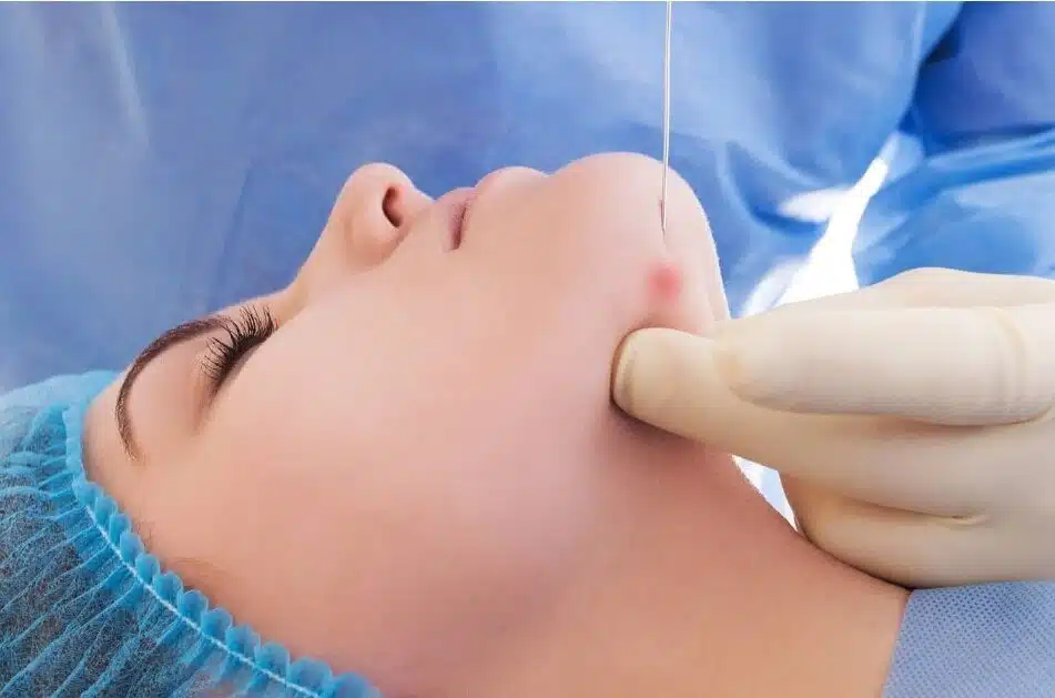 Endolift Skin Tightening for Face and Neck