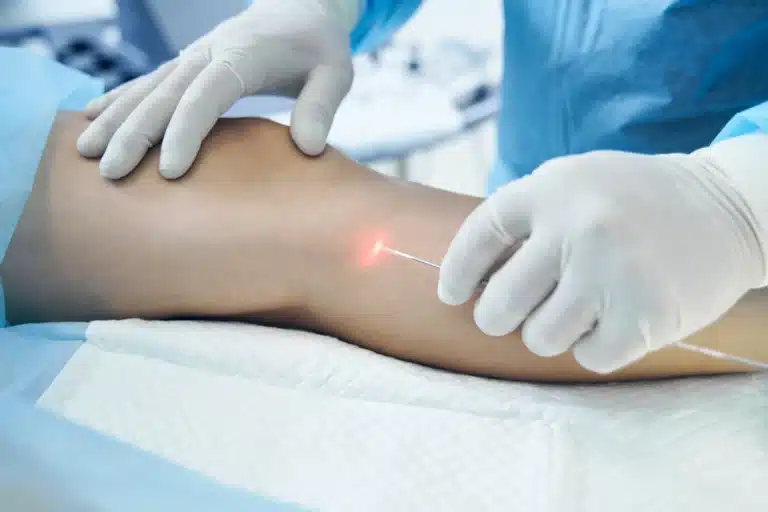 10 Key Facts About Endovenous Laser Ablation (EVLA)