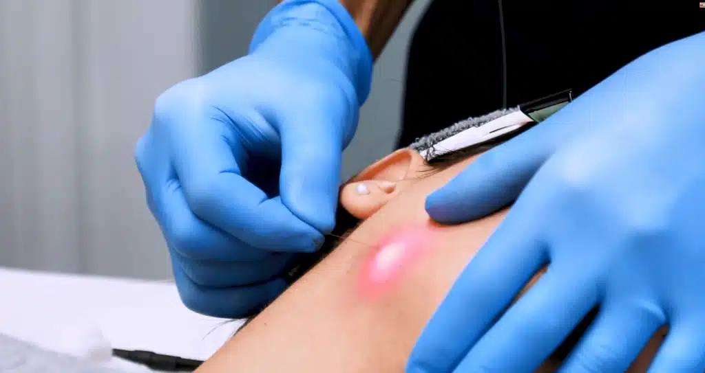 Endolift laser treatment device for sale