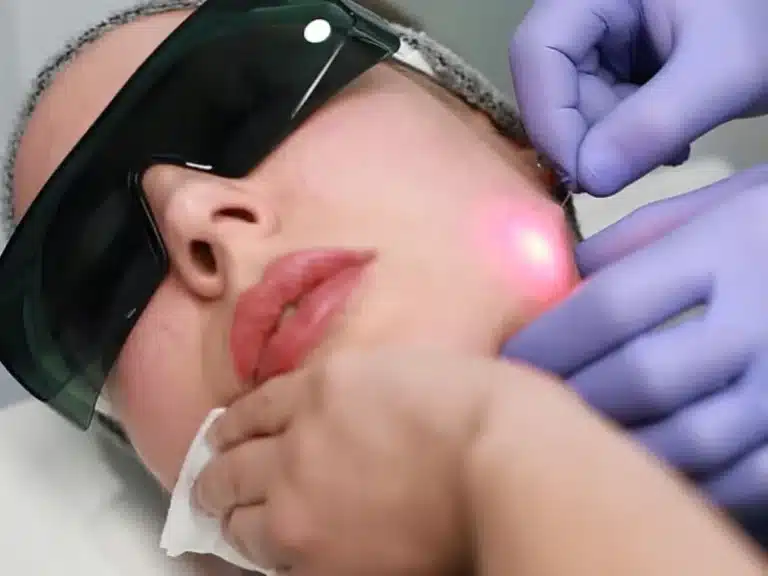 Youthful Skin with Endolift Everything You Need to Know