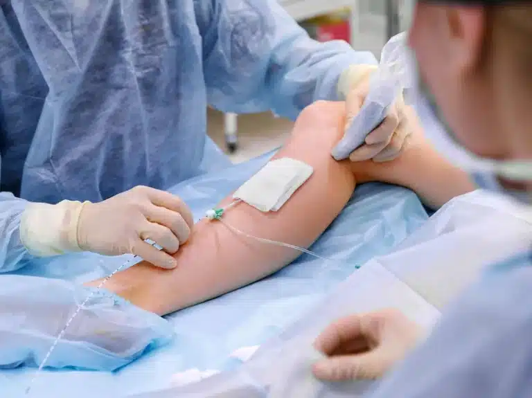 What To Expect After Endovenous Laser Vein Ablation (EVLA)