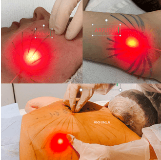 endolifting 980nm 1470nm laser lipolysis