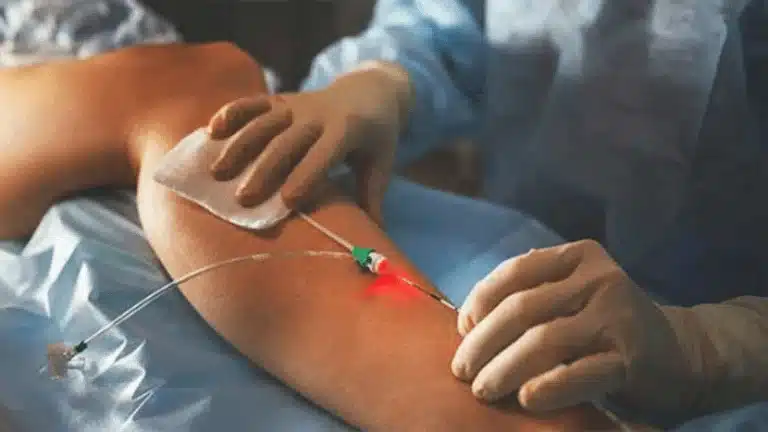 3 Advantages of Endovenous Laser Ablation Therapy EVLT