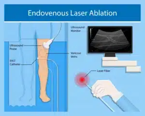 What is Endovenous Laser Treatment for Varicose Veins