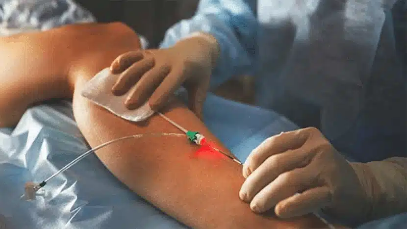 1470nm-evlt-varicose-vein-laser-treatment