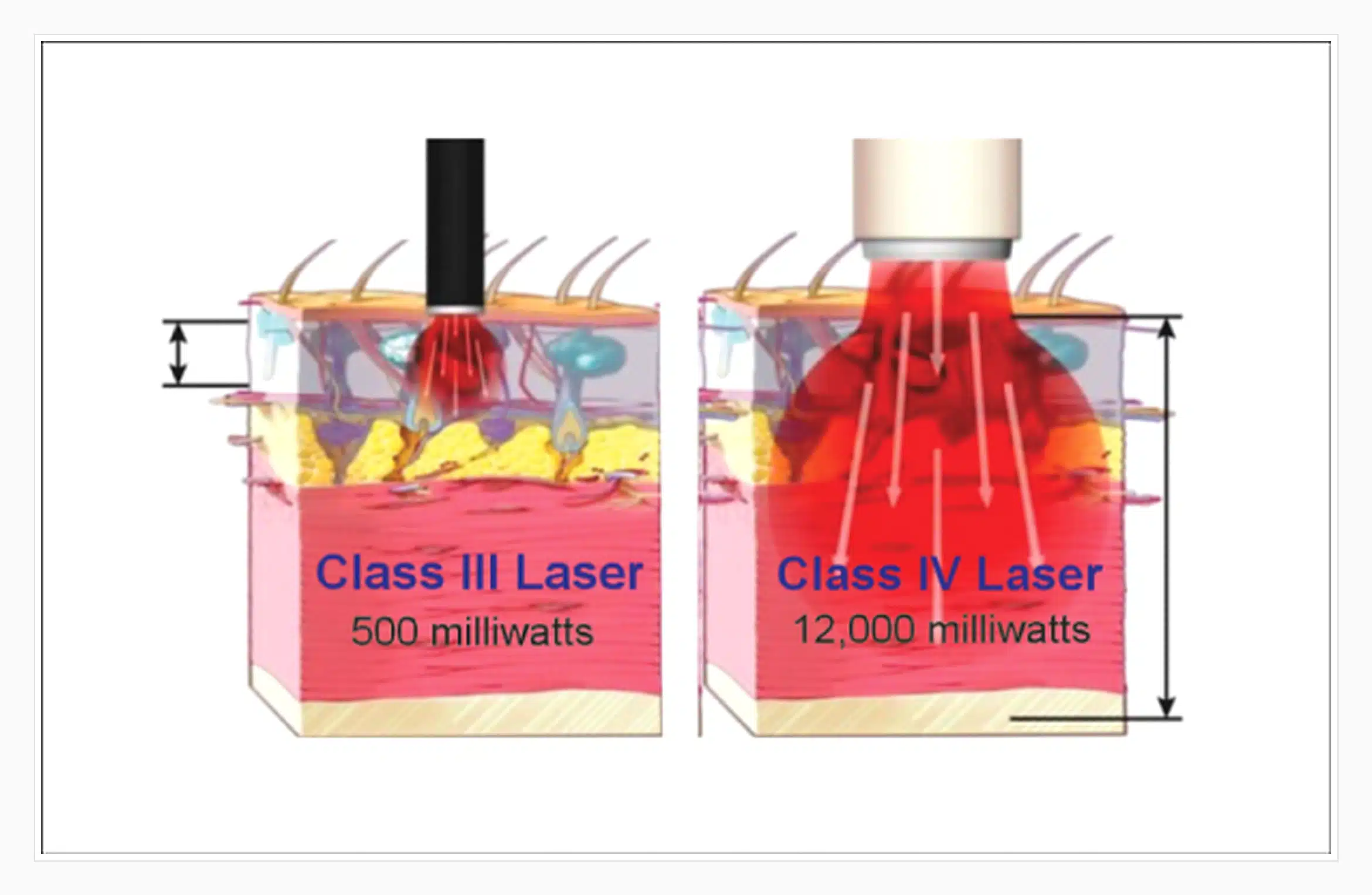 Class-III-vs-Class-IV-Laser-Power-Penetration-Comparison-Arfurla