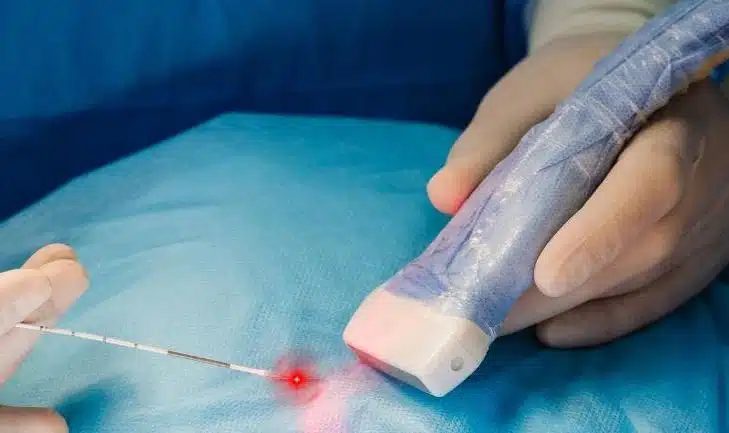 Endovenous laser ablation procedure on a leg
