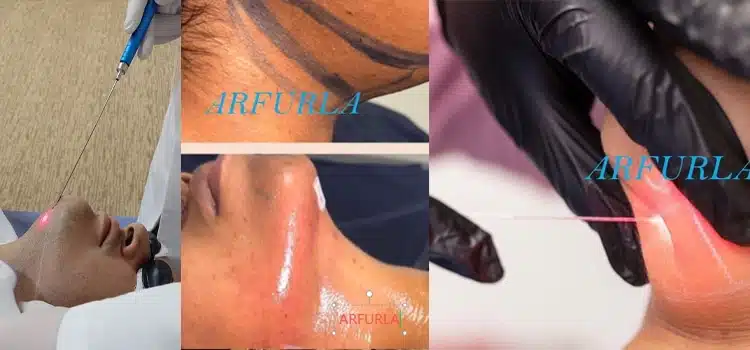 Laser-assisted lipolysis treatment using a fine optical fiber for facial and body contouring