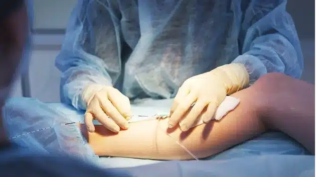 Laser fiber inserted into a leg vein during EVLA