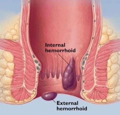 hemorrhoidss