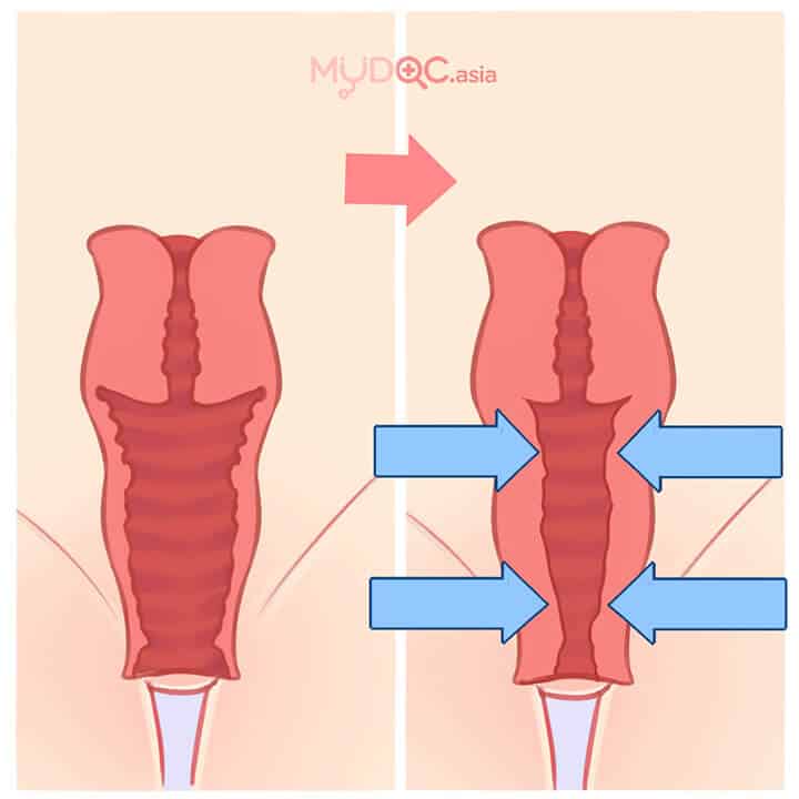 procedures-icon-laser-vaginal-tightening
