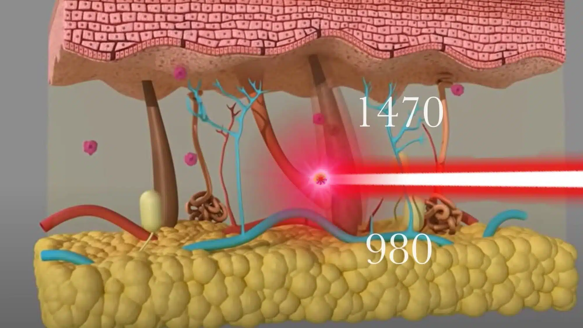 Conceptual illustration of 980nm and 1470nm fiber laser interaction with subdermal tissue