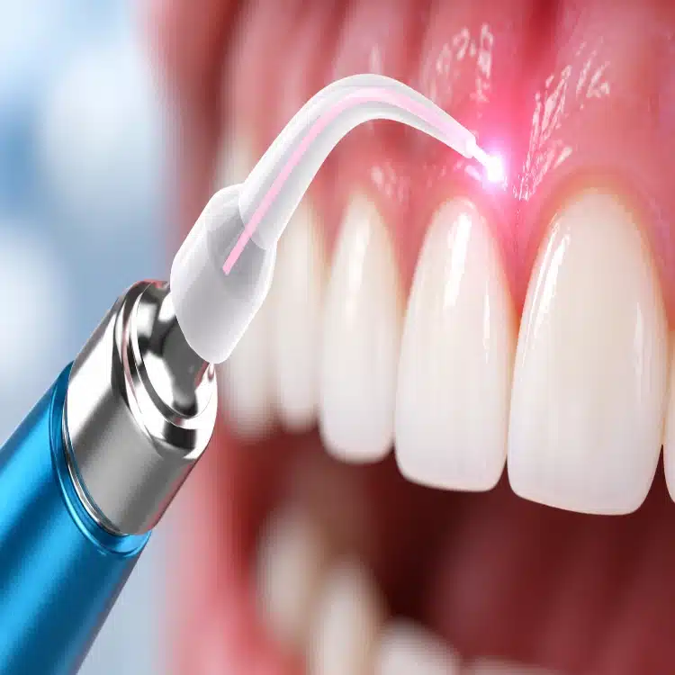 dental laser fiber tip for oral soft tissue procedures