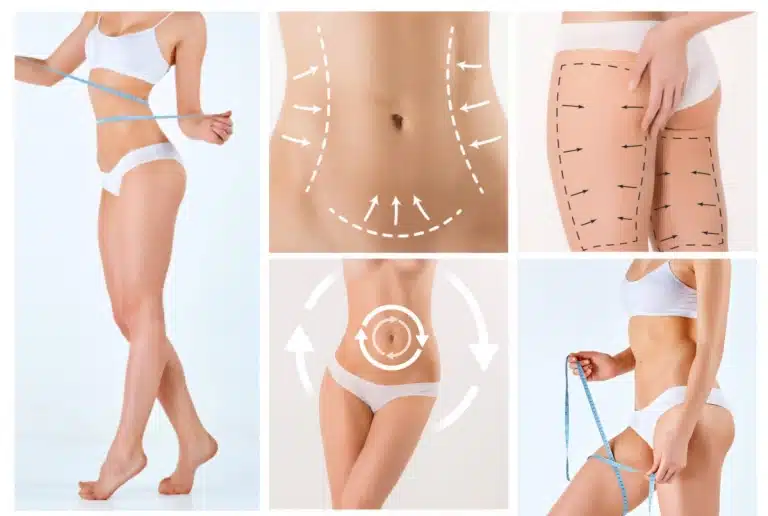 laser liposuction body contouring treatment areas